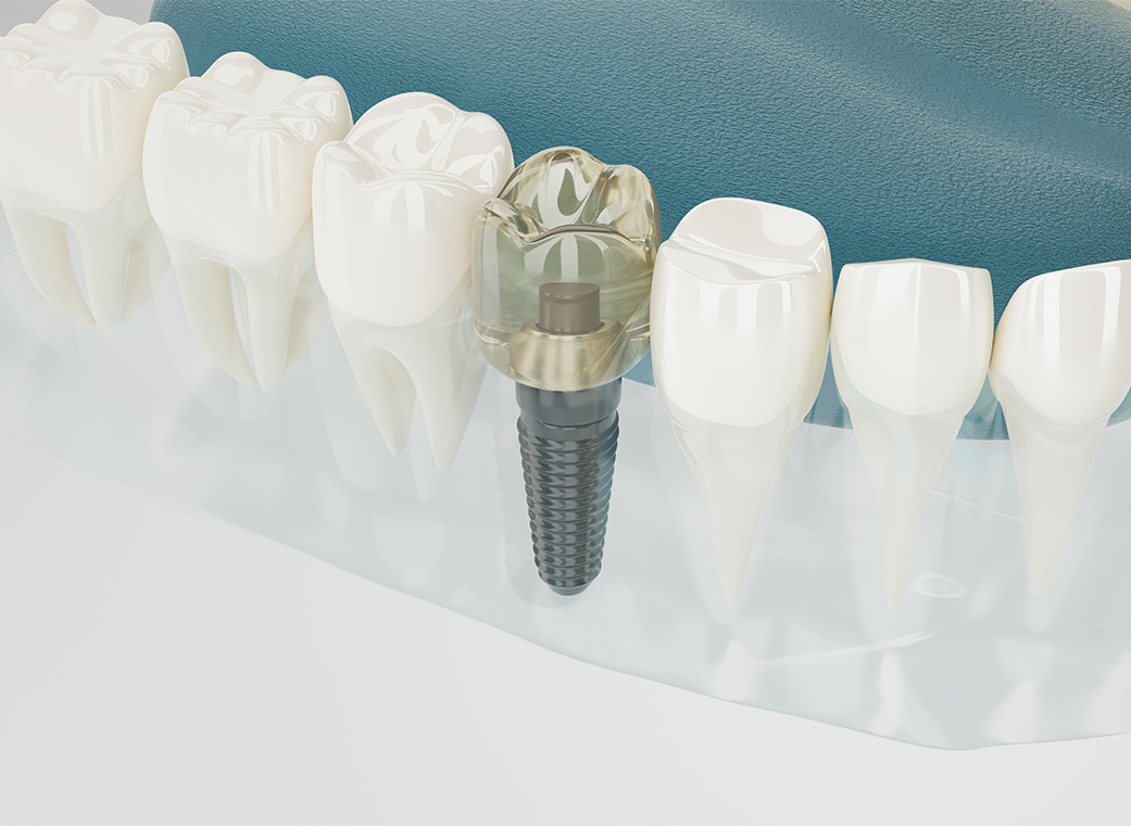 自分の歯のように食事や会話を楽しめる