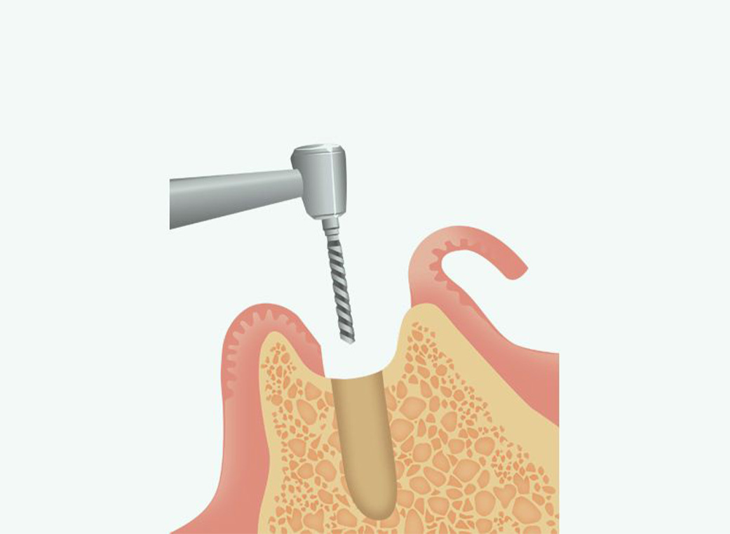 Step 03 インプラント体の埋入
