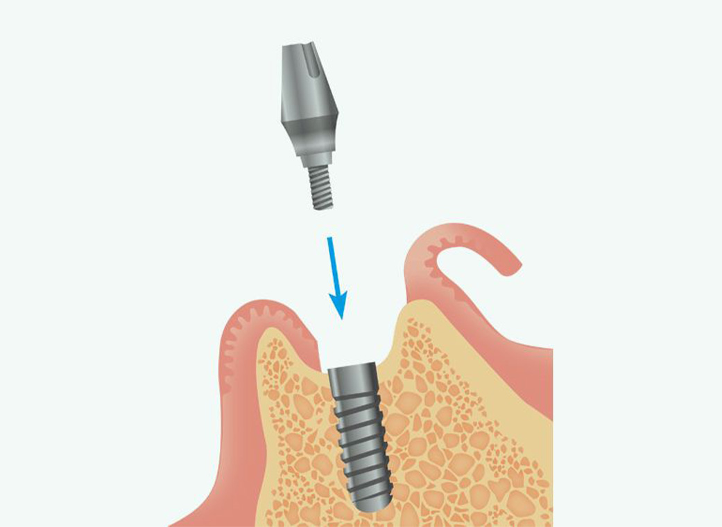 Step 04 アバットメントの装着