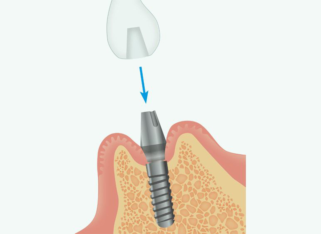 Step 05 人工歯の型取り、仮歯の装着