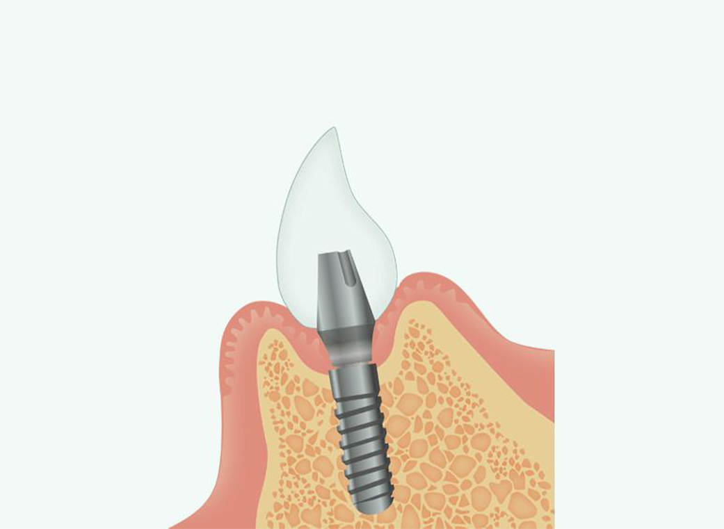 Step 06 人工歯の装着