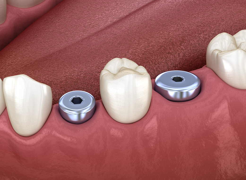 インプラント周囲炎