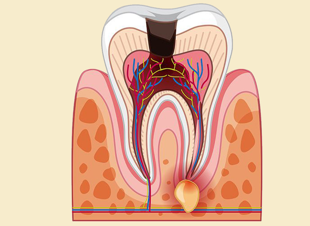 むし歯が神経まで広がると