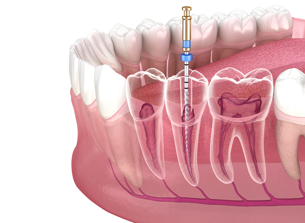 根管治療について