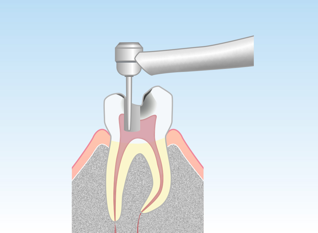 感染した神経の除去