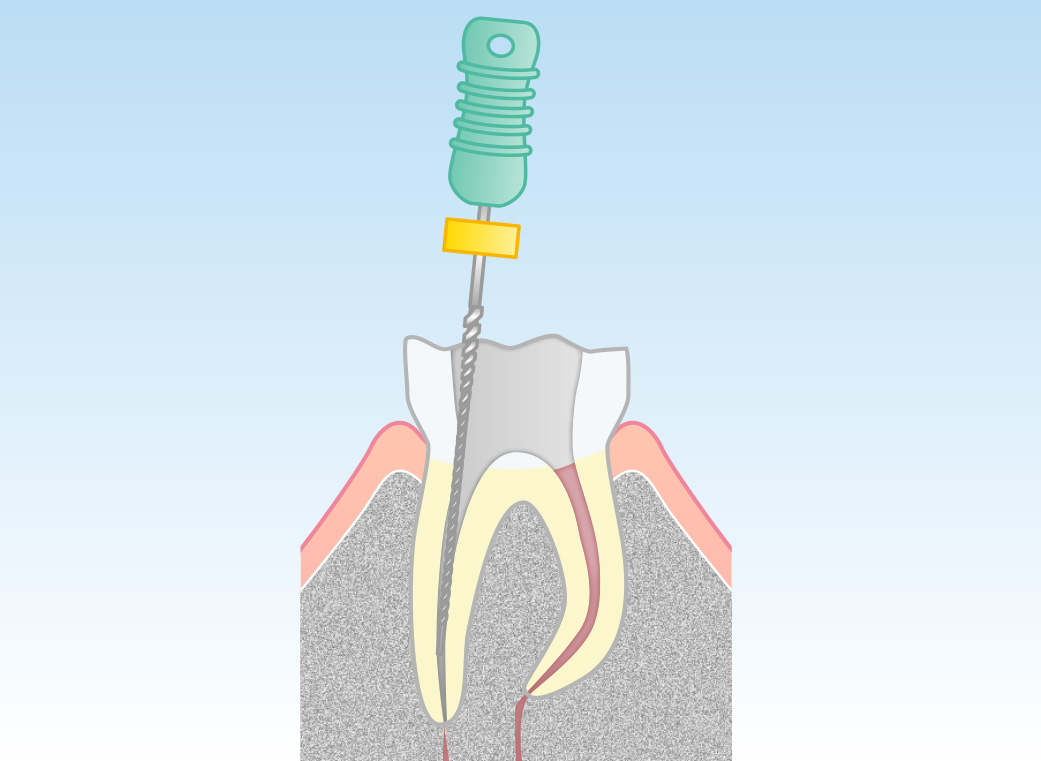 根管の清掃