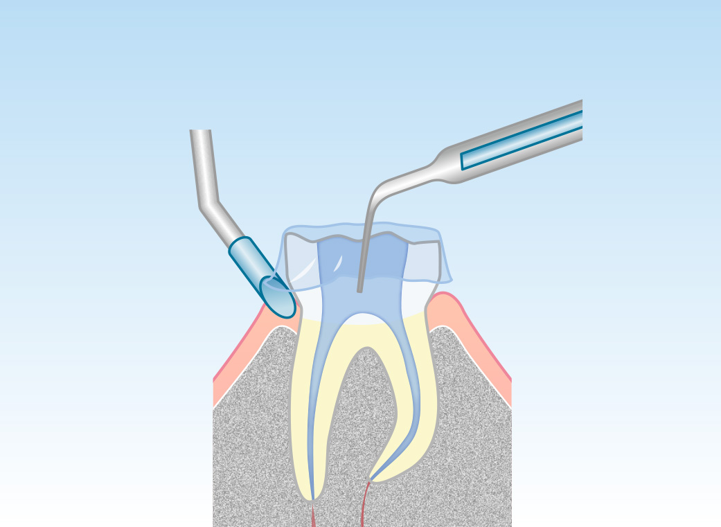 根管に充填剤を詰める