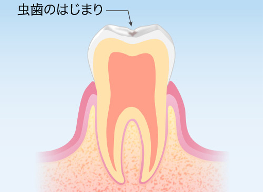 なぜむし歯になる？