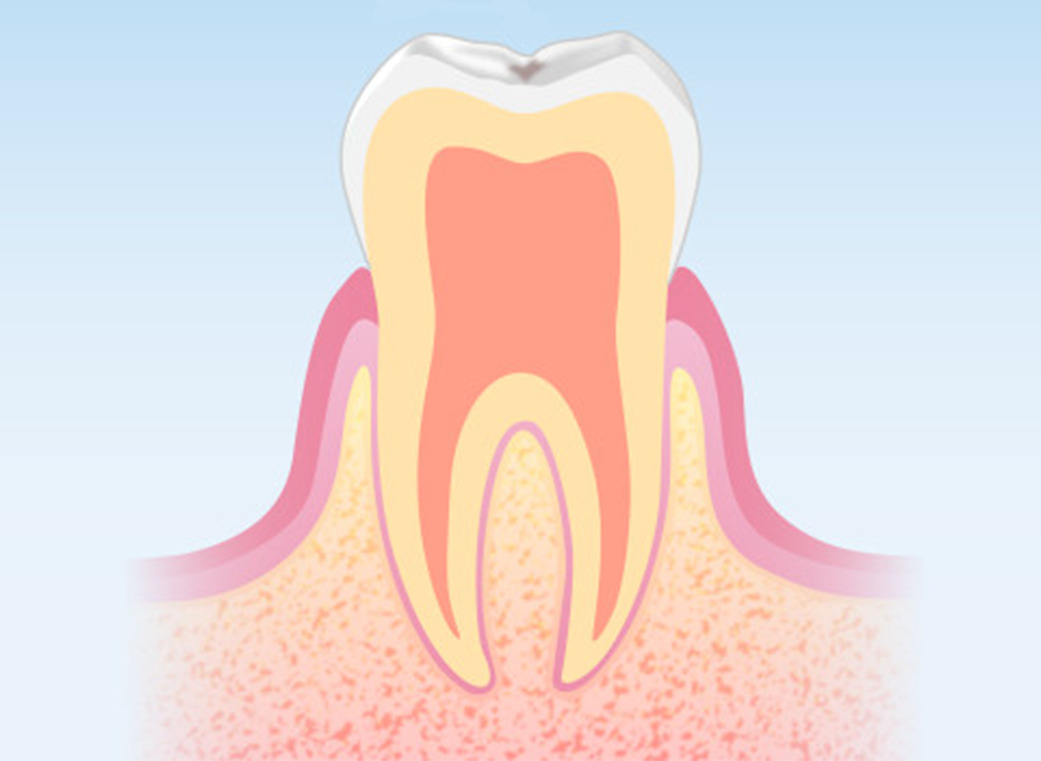 超初期むし歯(CO)