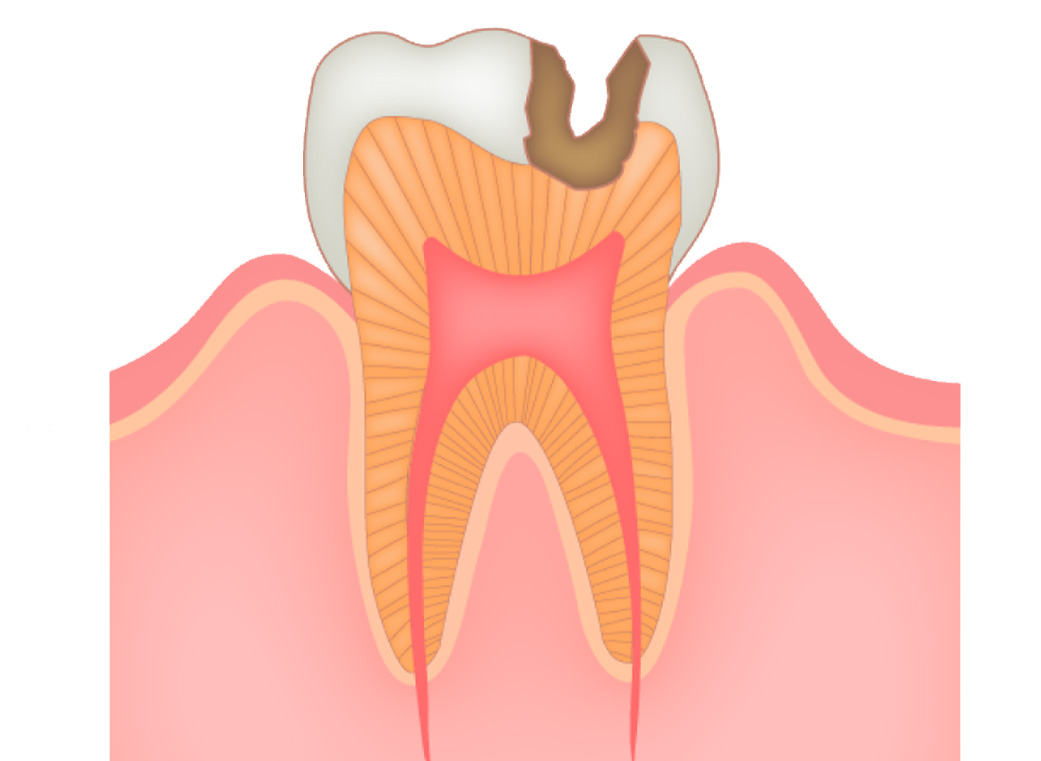 象牙質まで進行したむし歯(C2)