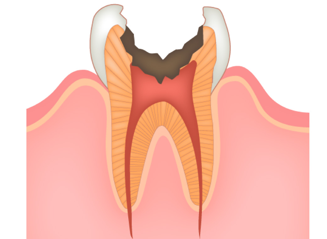 神経まで進行したむし歯(C3)