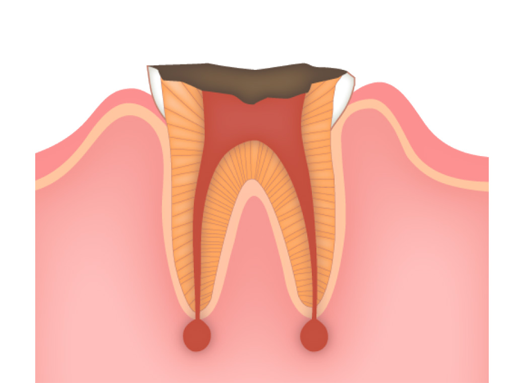 歯根だけ残ったむし歯(C4)