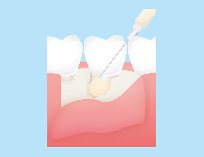 歯周組織の再生を促す「歯周組織再生療法」