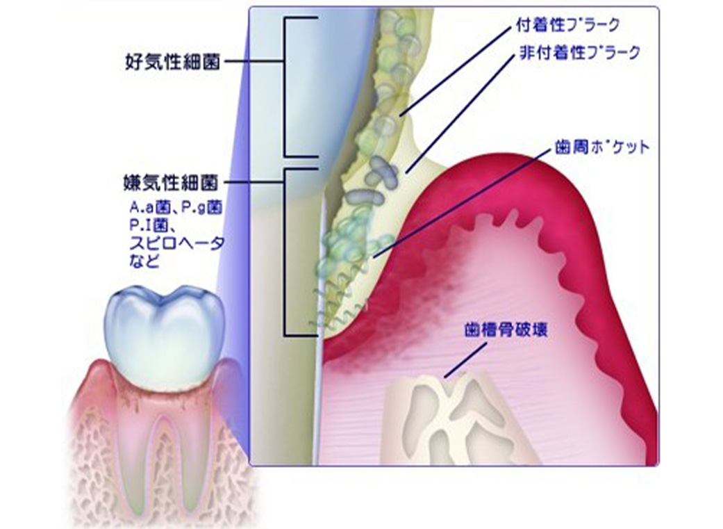 歯周病の原因