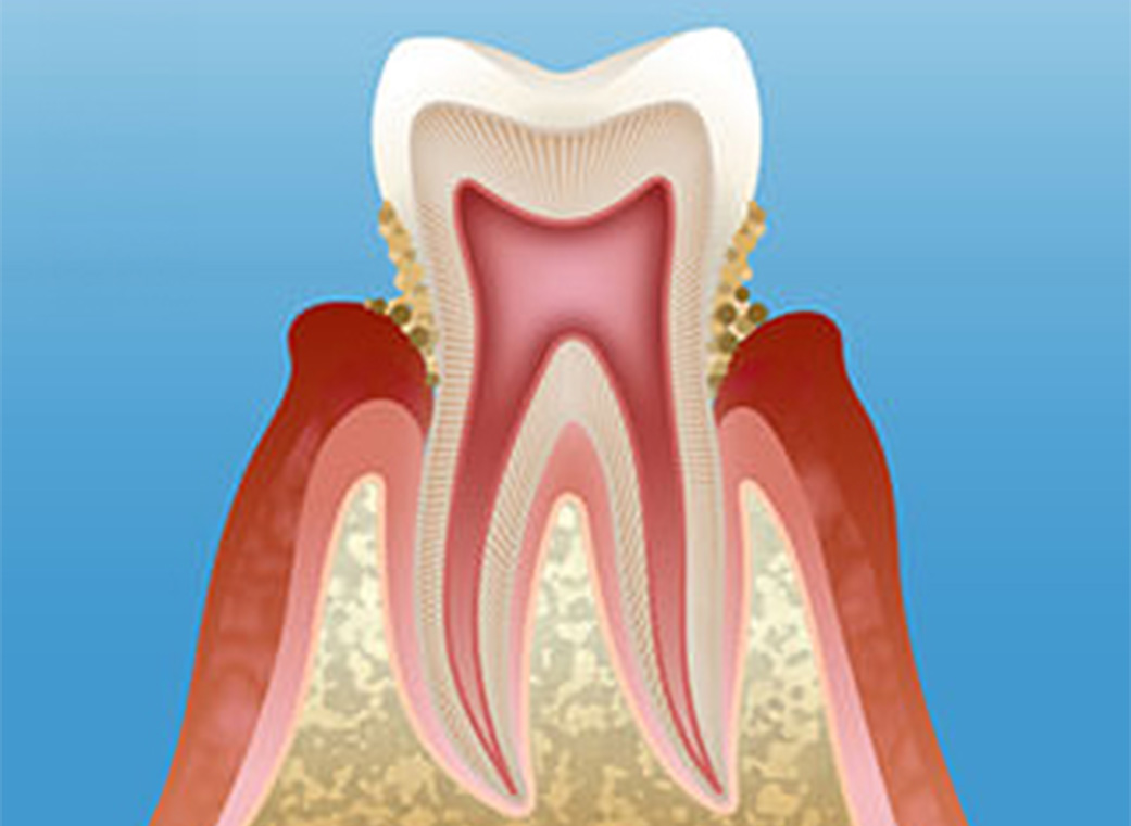 歯周炎（軽度）