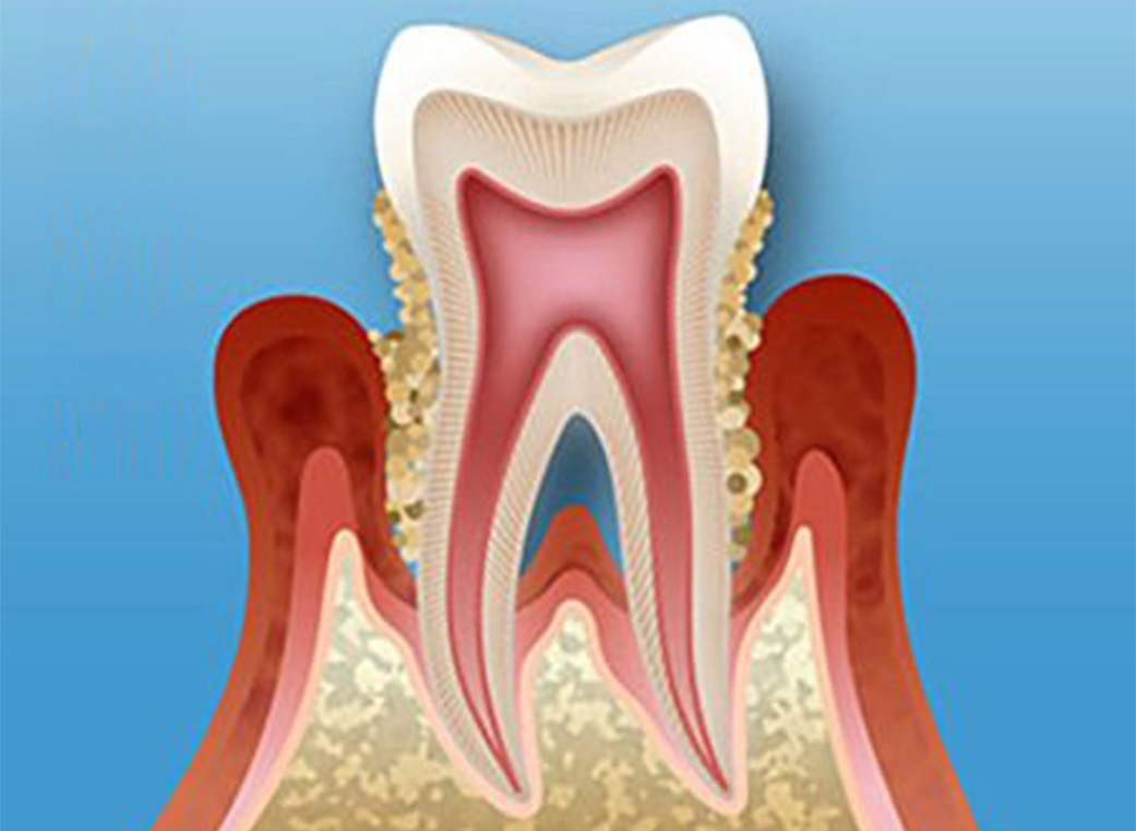 歯周炎（中度）
