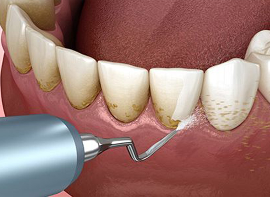 Step 03 初期治療