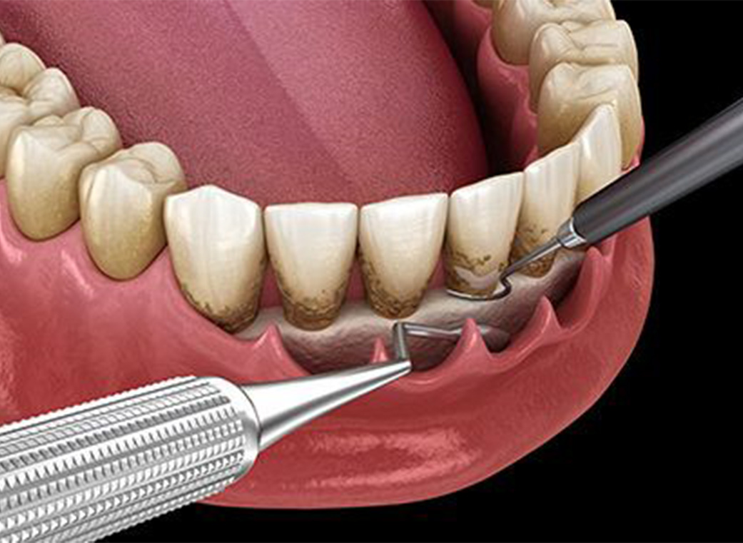 Step 04 進行した歯周病の治療