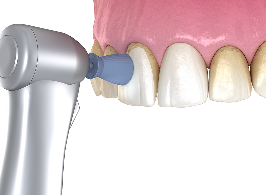 Step 04 歯のクリーニング